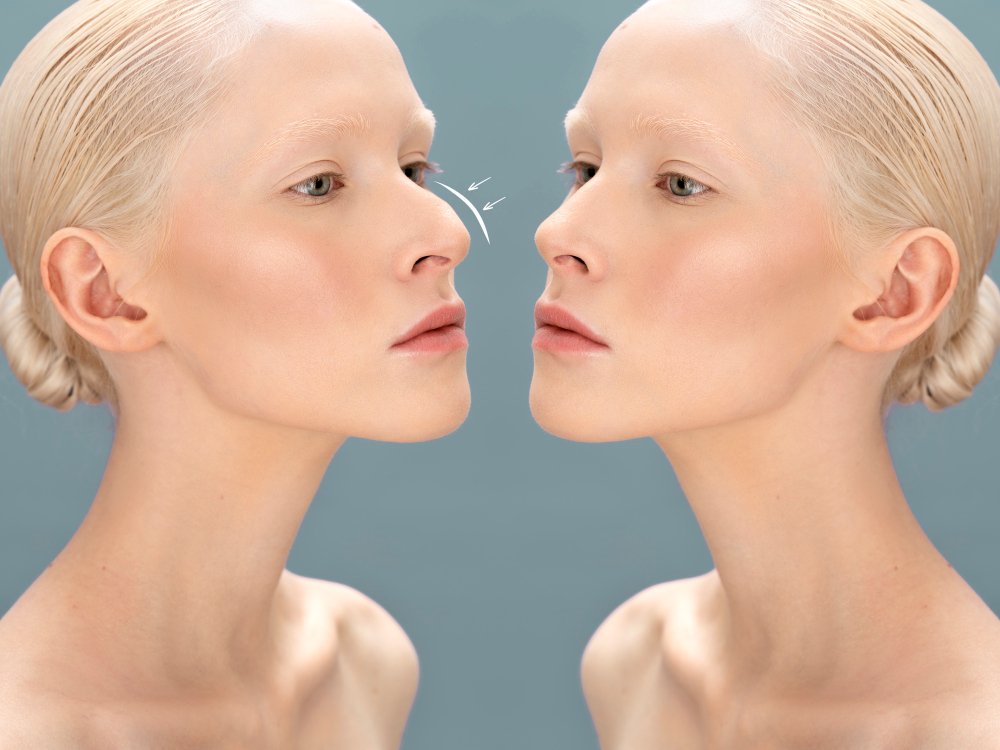 Nasolabial Folds