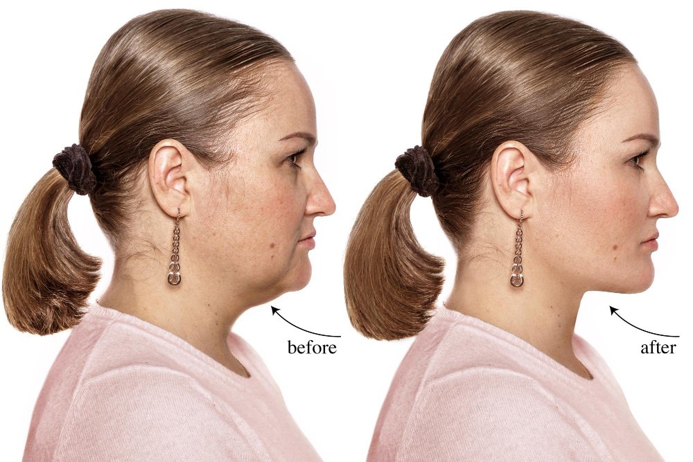 Jawline Filler