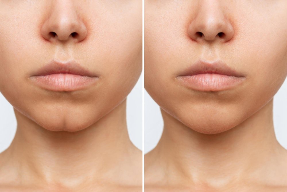Chin Filler