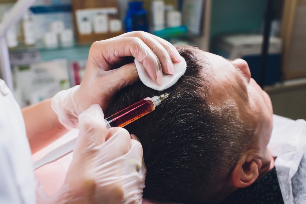 PRP Hair Restoration