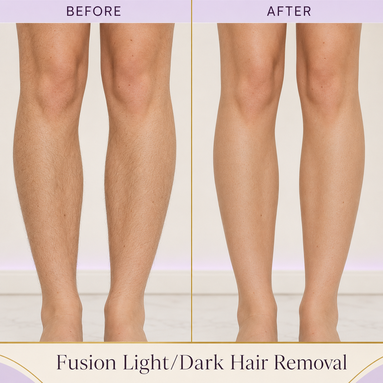 Fusion Hair Removal Before and After