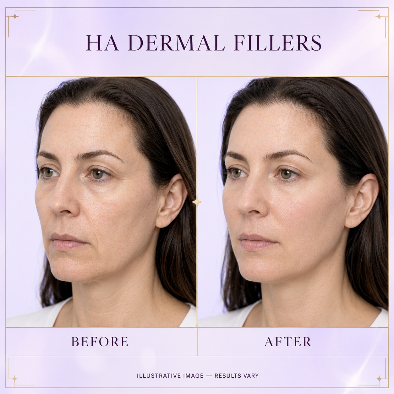 HA dermal fillers before and after