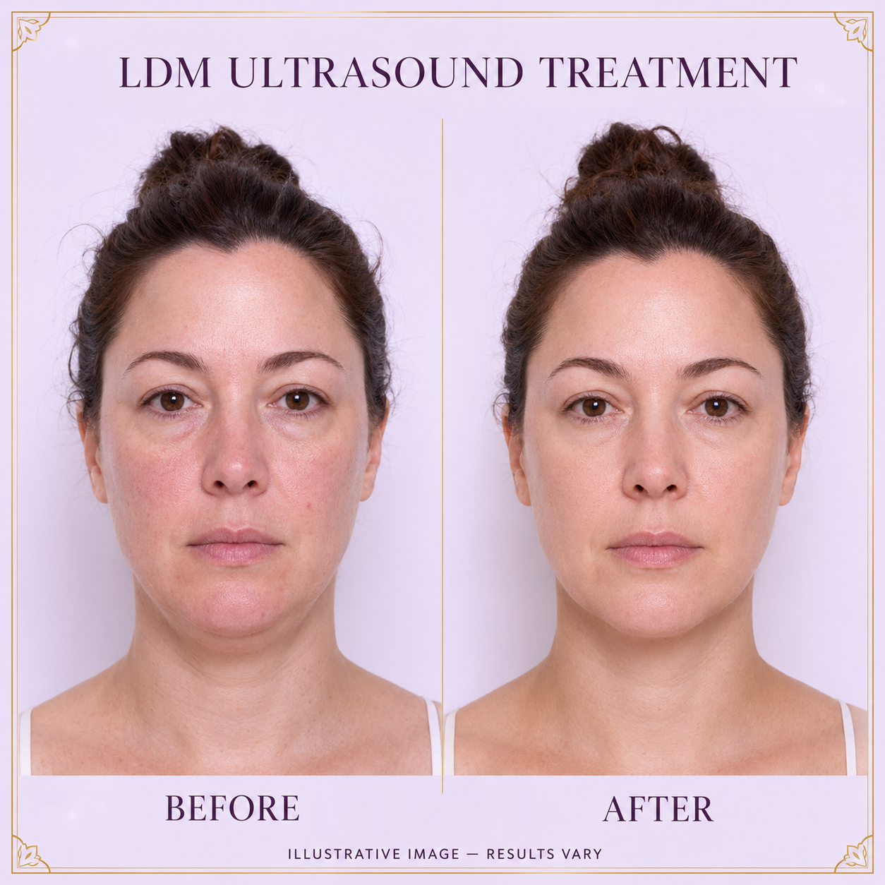 LDM ultrasound