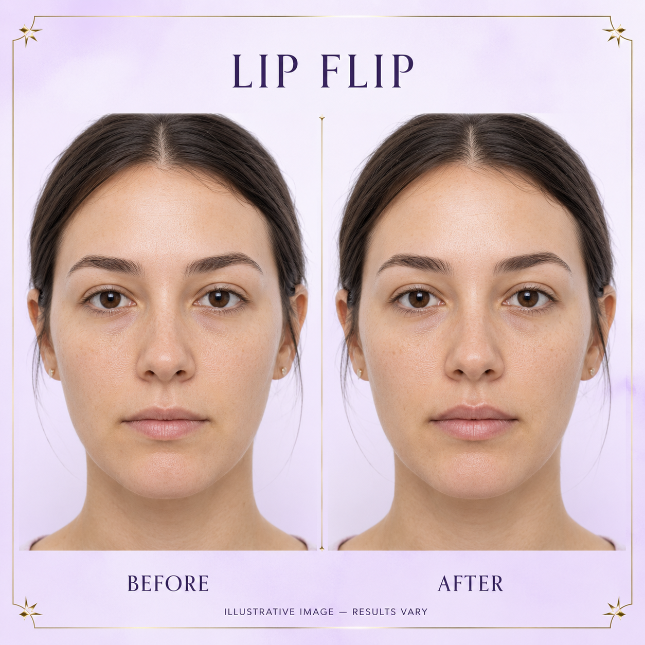 Lip flip before and after
