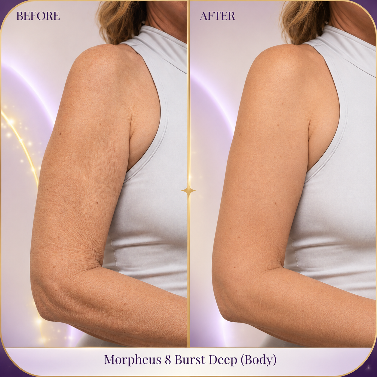 Morpheus 8 Body Firming Transformation